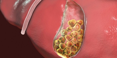Safra Kesesi Taşının Belirtileri Nelerdir?