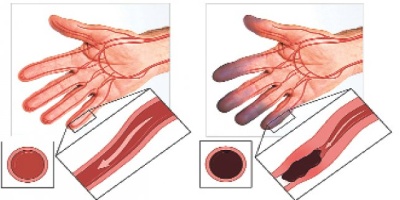 Buerger Hastalığı