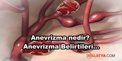Anevrizma nedir? Anevrizma Belirtileri Nelerdir?