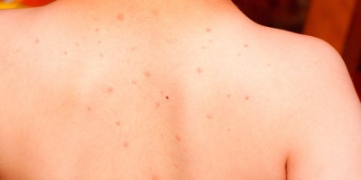 Sırtımda Kahverengi Lekeler Nasıl geçer?
