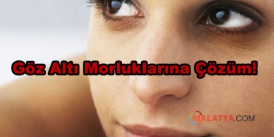 Göz Altı Morluklarına Çözüm!