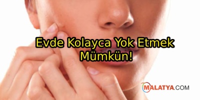 Siyah Noktalardan Kurtulmanın Yolları