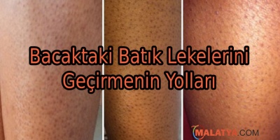 Bacaktaki Batık Lekeleri Nasıl Geçer?