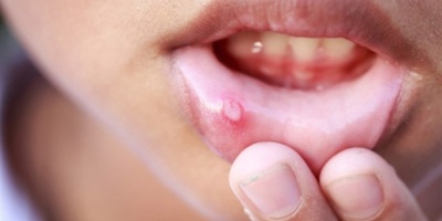 Ağız İçi Yaralara İyi gelen 5 Şey