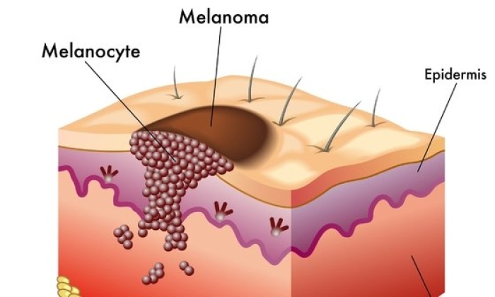 Malign Melanoma Hastası Ne Kadar Yaşar