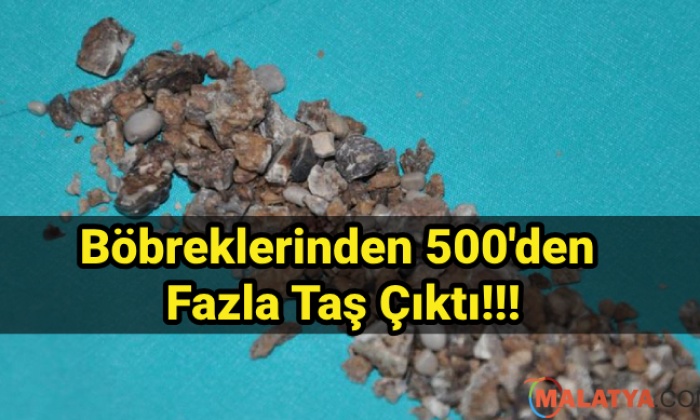 Böbreklerinden 500'den Fazla Taş Çıktı