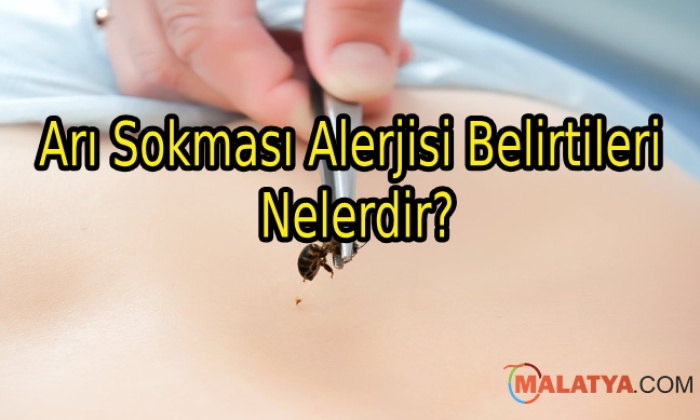 Arı Sokması Alerjisi Belirtileri Nelerdir?