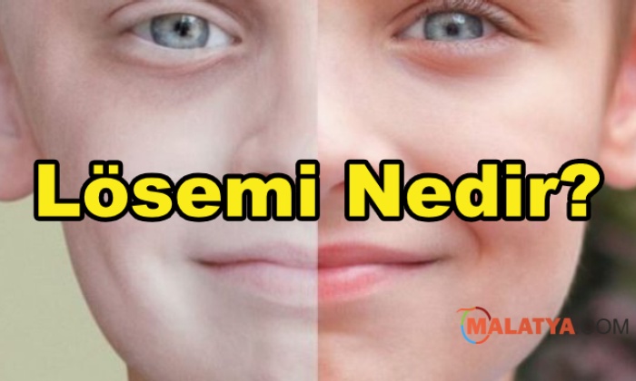 Lösemi Nedir?