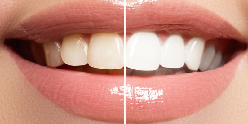 Dişler Neden Sararır? Diş Beyazlatma Teknikleri