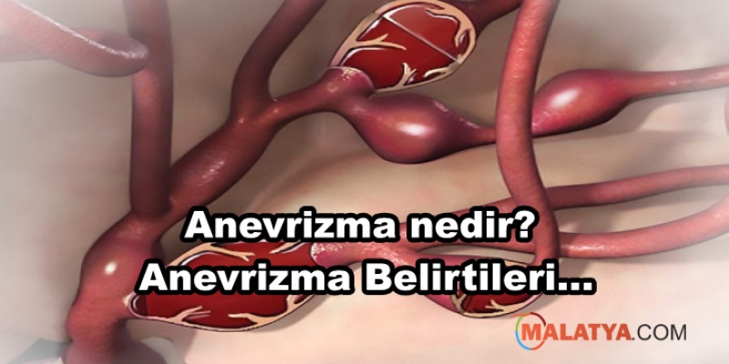 Anevrizma nedir? Anevrizma Belirtileri Nelerdir?