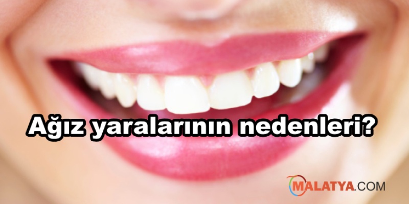 Ağız yaralarının nedenleri? Ağız yaralarına ne iyi gelir?