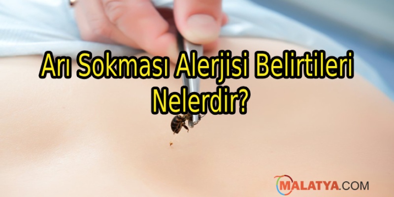 Arı Sokması Alerjisi Belirtileri Nelerdir?
