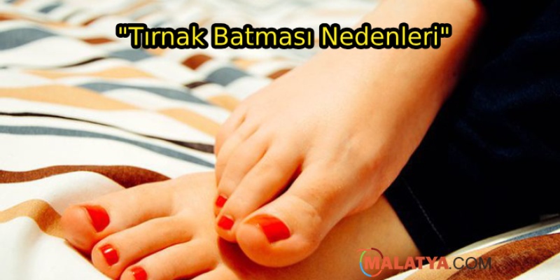 Tırnak Batması Neden Olur?