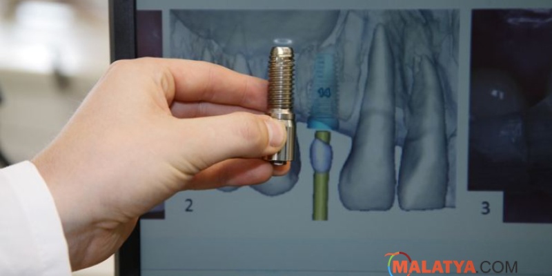 İmplant tedavisinde aylarca beklemeye son