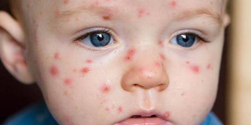 Su Çiçeği (Çiçek Hastalığı) Belirtileri Ve Tedavisi